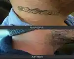 Tattoo Removal Courses